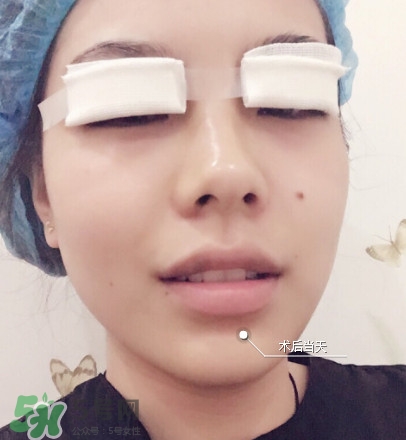 三点定位双眼皮全过程,做了三点定位双眼皮应该注意什么