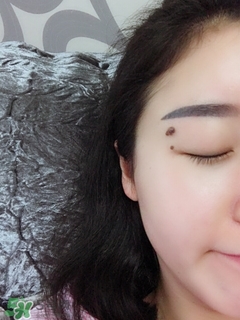 冷冻点痣的危害,冷冻点痣后要注意什么 冷冻点痣的危害,冷冻点痣后要注意什么