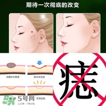 激光点痣和药水点痣哪个更好,药水点痣好还是激光点痣好 激光点痣和药水点痣哪个更好,药水点痣好还是激光点痣好