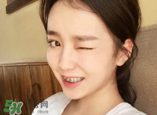 戴牙套会不会影响嘴型,戴牙套会改变唇形吗 戴牙套会不会影响嘴型,戴牙套会改变唇形吗