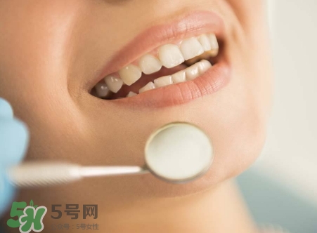 洗牙应该隔多久洗一次,洗一次牙多长时间能洗完