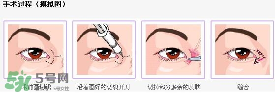 什么样的眼睛需要开眼角图片,什么人适合开眼角图片