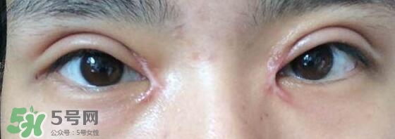 眼角增生是怎么引起的,眼角有增生 眼角增生是怎么引起的,眼角有增生