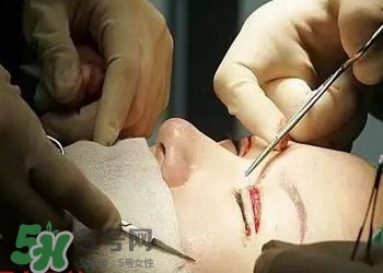 割双眼皮要疼几天能好,割了双眼皮多久才不痛