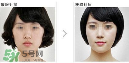 打瘦脸针可以喝酒吗?,打瘦脸针前可以喝酒吗