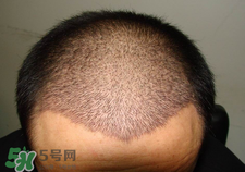 光头可以种植头发吗,植发一定要剃光头吗 光头可以种植头发吗,植发一定要剃光头吗