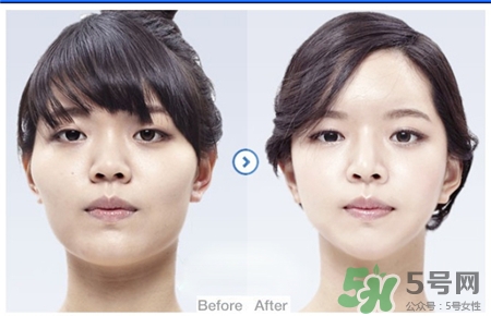 保妥适瘦脸针大概多少钱,botox瘦脸针的价格是多少