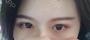 定点双眼皮是永久吗,定位双眼皮是永久吗