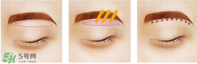 切完眉眼睛肿怎么办,切眉后眼睛肿怎么消肿 切完眉眼睛肿怎么办,切眉后眼睛肿怎么消肿