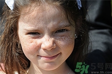 激光祛斑后洗脸会怎样,激光祛斑后能洗脸洗澡吗