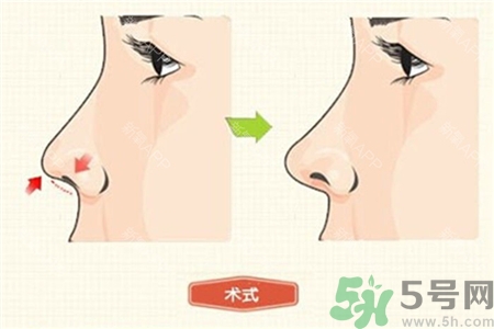 什么是线雕隆鼻可以维持多久,线雕隆鼻手术过程 什么是线雕隆鼻可以维持多久,线雕隆鼻手术过程