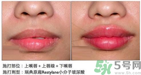 玻尿酸丰唇能保持多长时间,玻尿酸丰唇怎么样可以维持时间长