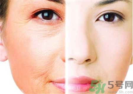 除皱针是不是肉毒素,肉毒素和除皱针有什么区别 除皱针是不是肉毒素,肉毒素和除皱针有什么区别