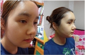 削骨瘦脸痛吗,削骨瘦脸手术风险高吗 削骨瘦脸痛吗,削骨瘦脸手术风险高吗