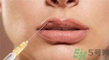 玻尿酸丰唇几天消肿自然,玻尿酸丰唇后肿胀几天