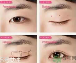 埋线双眼皮怎么做,刚做好埋线双眼皮图片