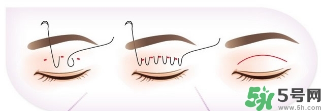 双眼皮手术应该做哪些,割双眼皮需要注意哪些 双眼皮手术应该做哪些,割双眼皮需要注意哪些