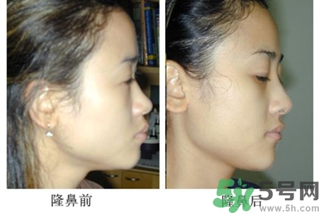 整鼻子打玻尿酸会有副作用,玻尿酸隆鼻的危害性有哪些
