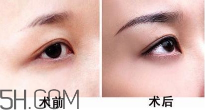切眉手术后老得快,切眉以后是不是老得快 切眉手术后老得快,切眉以后是不是老得快