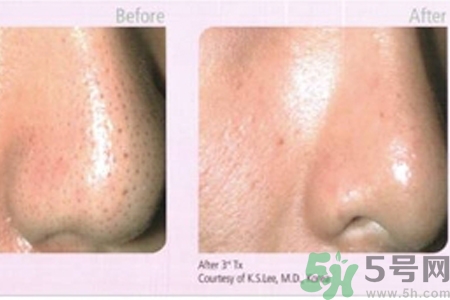 激光能改善毛孔粗大吗,激光毛孔粗大有效果吗