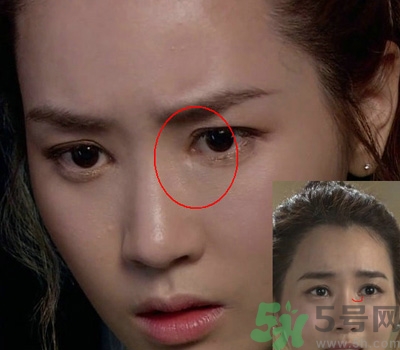 开眼角多少钱一般多少钱,单独开眼角多少钱