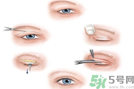 双眼皮手术有几种割双眼皮多少钱,一般割双眼皮多少