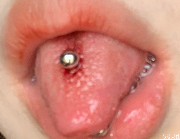 打舌钉多久能吃饭,打完舌钉多久可以正常吃饭