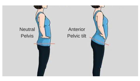 骨盆倾斜是怎么造成的,骨盆前倾是什么原因造成的