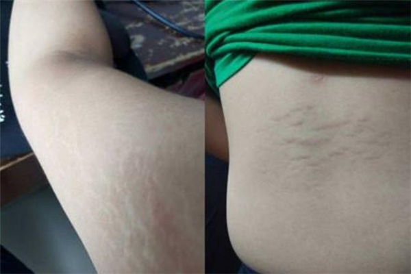 长了肥胖纹怎么办,红色肥胖纹瘦下来可以消除吗