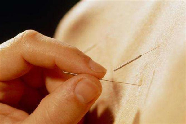 针灸减肥会不会影响怀孕,针灸真的能减肥吗 针灸减肥会不会影响怀孕,针灸真的能减肥吗