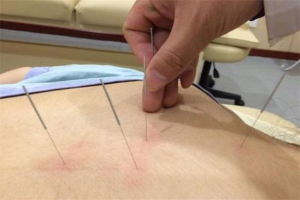 经期可以针灸减肥吗,针灸真的能减肥吗 经期可以针灸减肥吗,针灸真的能减肥吗