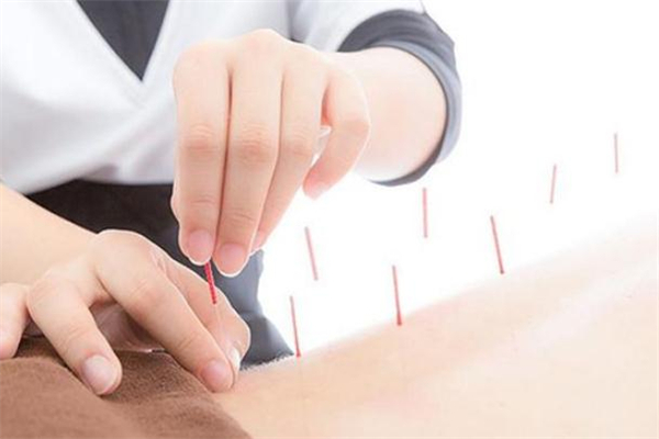 针灸可以减肥么,针灸减肥效果好吗