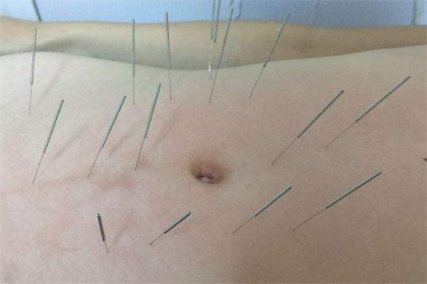 减肥针灸哪个部位最好,减肥针灸什么部位图解