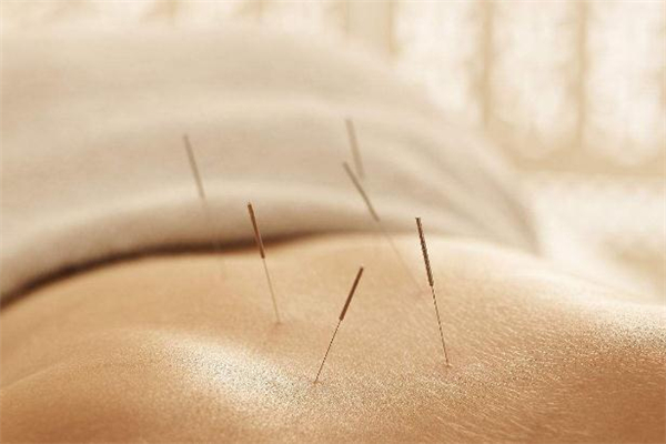 针灸减肥一个疗程多少天,针灸减肥一个月能瘦多少斤 针灸减肥一个疗程多少天,针灸减肥一个月能瘦多少斤