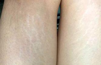 大腿上出现肥胖纹,大腿上有肥胖纹是怎么回事