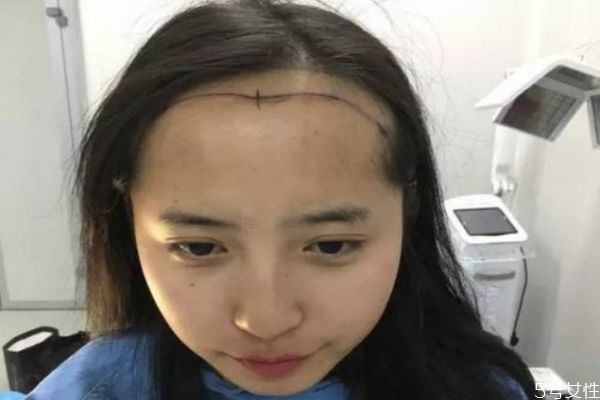 额头大怎么办啊,额头太大太宽怎么办