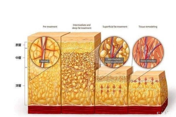 脂肪会燃烧吗,脂肪燃烧到底是怎么回事