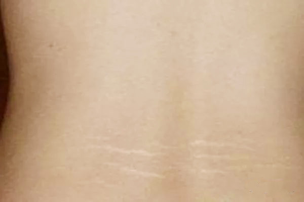 减肥能消除肥胖纹吗,瘦了之后身上的肥胖纹会消失吗