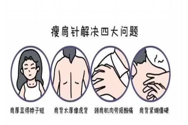 瘦肩针一次打多少剂量,瘦肩针要打几次 瘦肩针一次打多少剂量,瘦肩针要打几次