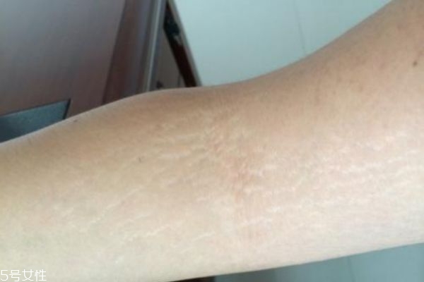 什么是肥胖纹呢,肥胖纹是什么样
