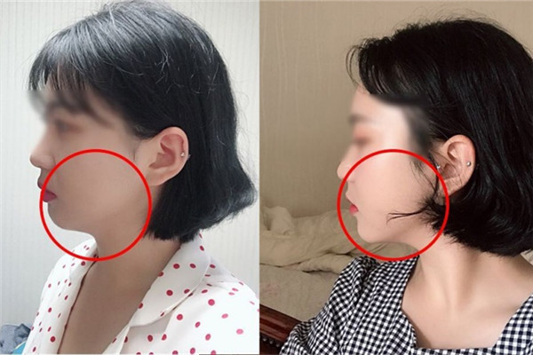 耳贴的减肥的位置,面部提升耳贴的方法