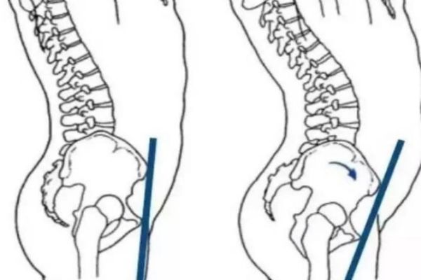 小女孩骨盆前倾怎么办,怎样治疗骨盆前倾