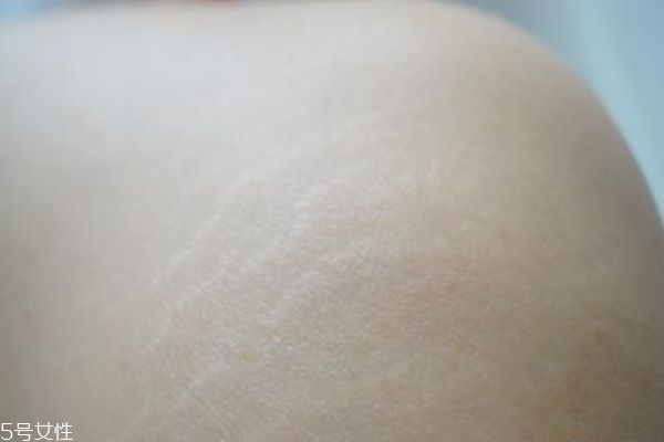 长肥胖纹是胖了还是瘦了,腿上有肥胖纹是胖了还是瘦了 长肥胖纹是胖了还是瘦了,腿上有肥胖纹是胖了还是瘦了