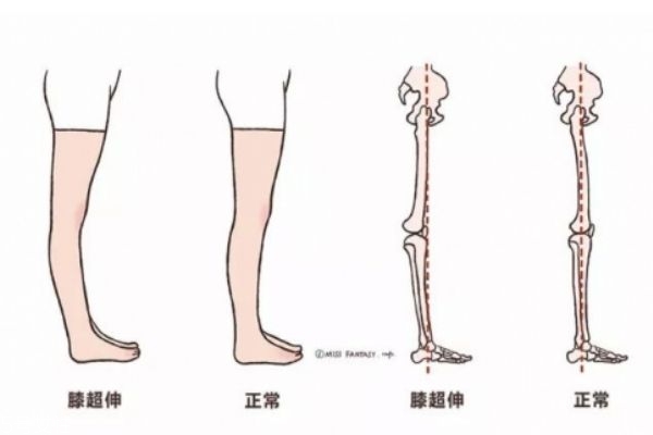 膝盖超伸怎么矫正,怎样改善膝超伸