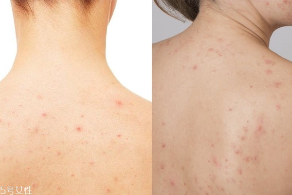 怎么区分痘痘和毛囊炎,怎么区分毛囊炎