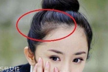 发际线低可以脱毛吗,发际线脱毛有风险吗