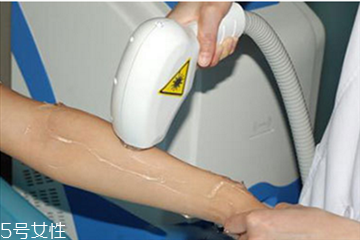 冰点脱毛对身体有害吗,冰点脱毛危险吗