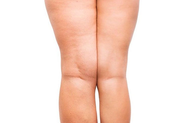 减肥后有橘皮纹怎么消除,橘皮纹会自己淡化吗