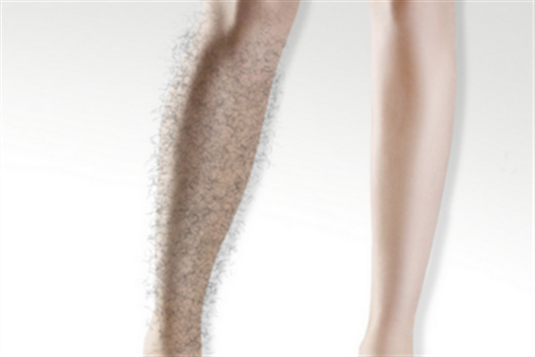 激光脱毛的利弊,激光脱毛的害处