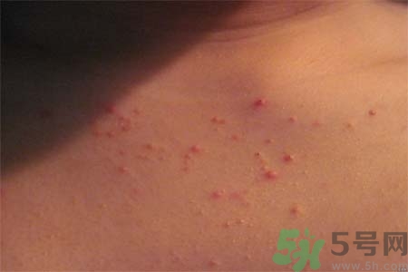 胸部长痘怎么回事,女性胸部长痘痘怎么回事